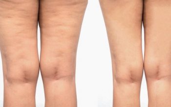 Tips to do every day and lose cellulite