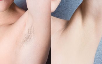 Laser Hair Removal VS Electrolysis Hair Removal: Which is better?