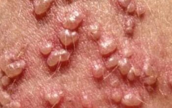 Importance of Herpes Cure