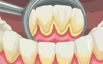 The Impact of a Calculus Bridge on Your Dental Health