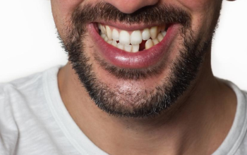 Why Should You Replace Missing Teeth?