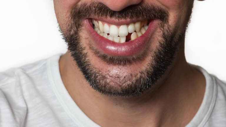 Missing Teeth